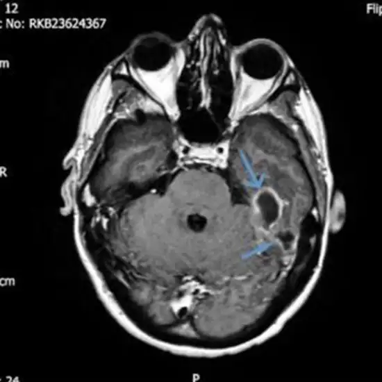 MRI Screening of Inner Ear
